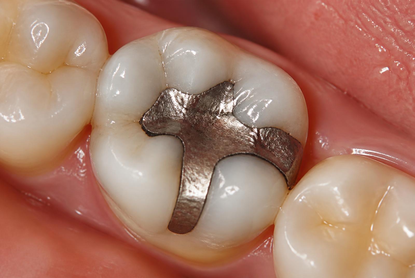 Amalgam- & Metallentfernung (KI-generiertes Symbolbild)